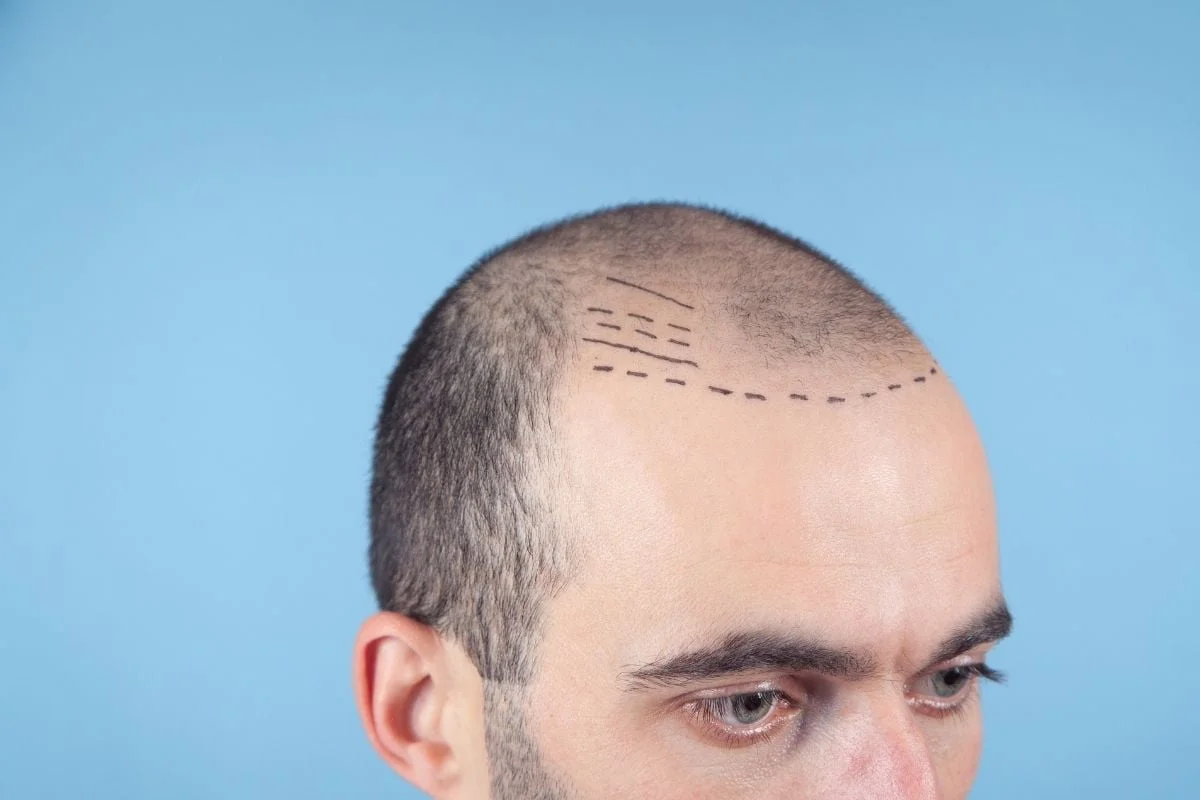 Пересадка волос мужчине 2023