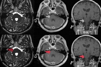 Brain Tumor x-ray Antalya Turkey