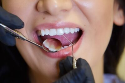 Dental Clinic Veneers