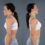 Kyphosis in Turkey