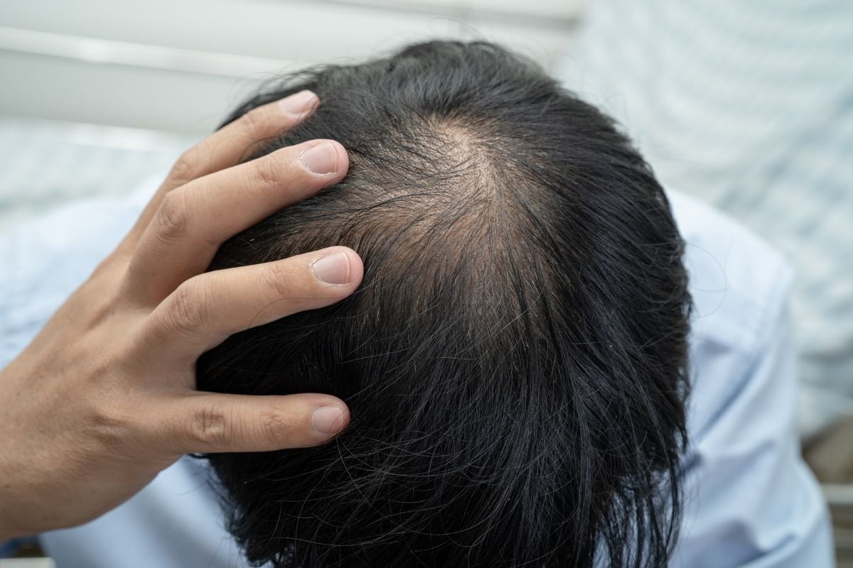 Hair Transplant Costs in Turkey Hair Transplant Man